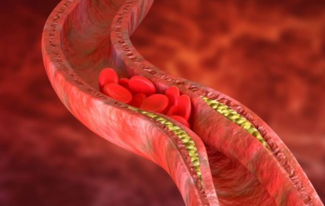 Czy można obniżyć poziom złego cholesterolu bez stosowania leków?
