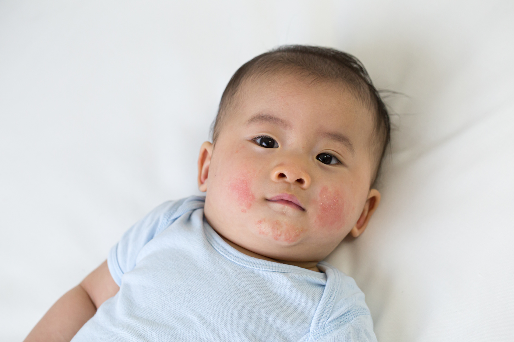 Atopowe zapalenie skóry u niemowlaka – jak sobie z nim radzić?